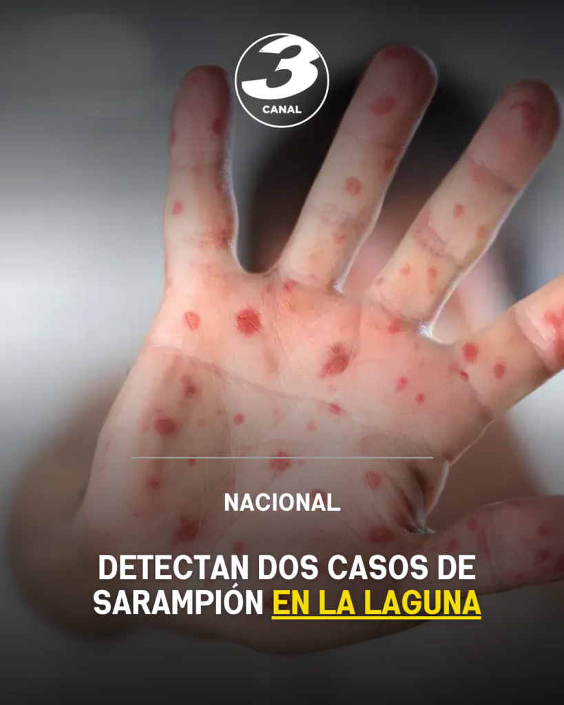 Detectan dos casos de sarampión en La Laguna