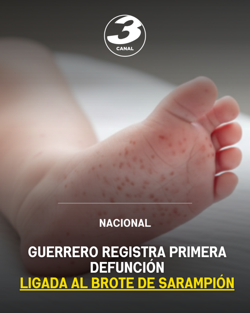 Guerrero registra primera defunción ligada al brote de sarampión