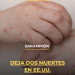 Sarampión deja dos muertes en EE.UU.